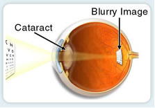 cataract